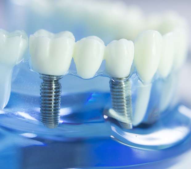 Swampscott Dental Implants