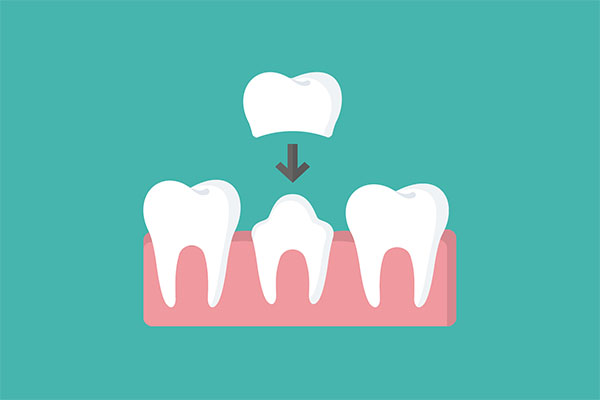 How A CEREC Crown Can  Restore A Broken Tooth