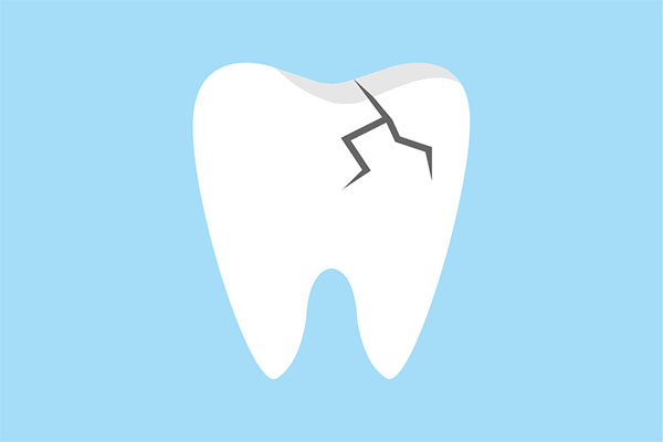 How A Damaged Tooth Is Prepared For A CEREC Crown
