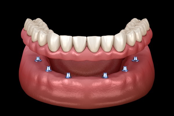 Signs You Should Talk To Your Dentist About Implant Dentures