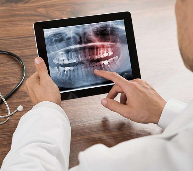 Swampscott Types of Dental Root Fractures