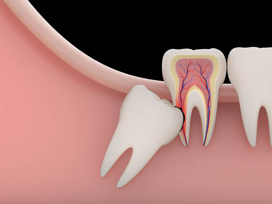 How Long Is Recovery After Wisdom Tooth Extraction?